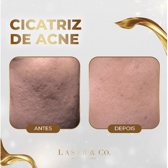 Cicatriz de Acne - 5 Sessões - Laser & Co.