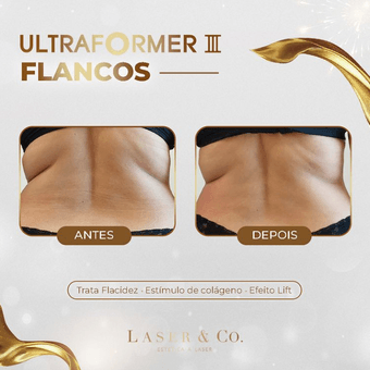 Ultraformer - Flancos - 3 Sessões - Laser & Co.