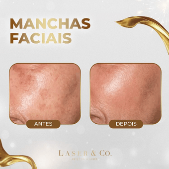 Manchas Faciais - 5 Sessões - Laser & Co.