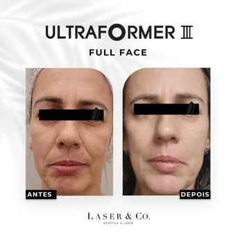 Ultraformer - Full Face - 3 Sessões - Laser & Co.